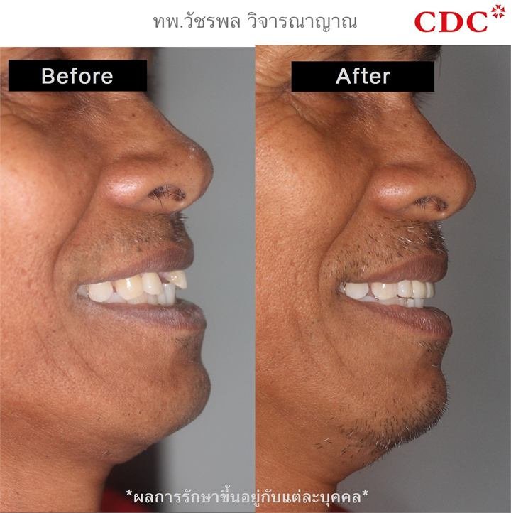Before and after dental implant treatment showing natural-looking results