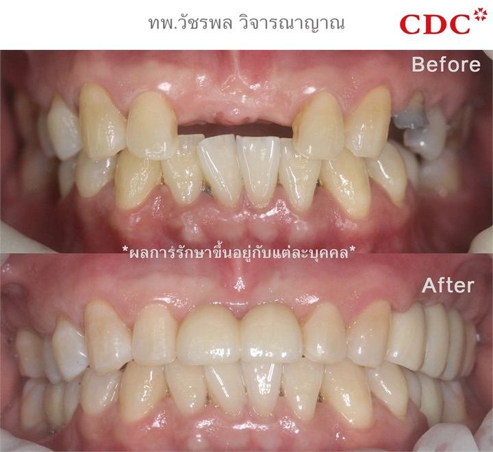 Strong dental implant results with excellent chewing function