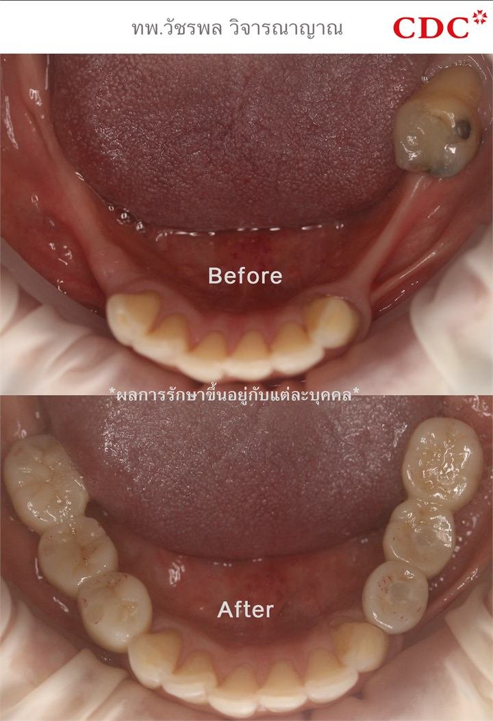 Permanent fixed dentures that don't need to be removed